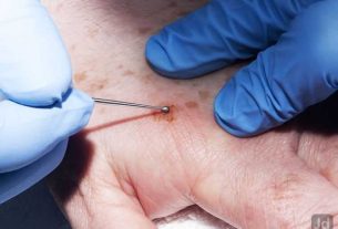 Mole Removal Ultimate Guide for Clear Skin