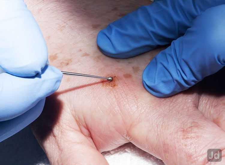 Mole Removal Ultimate Guide for Clear Skin